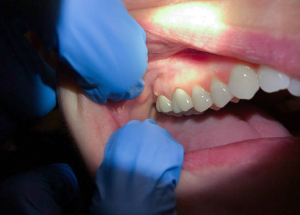 Best Emergency Root Canal Treatment in Sheridan, IN